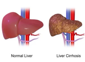 Liver Transplantation in Algeria: