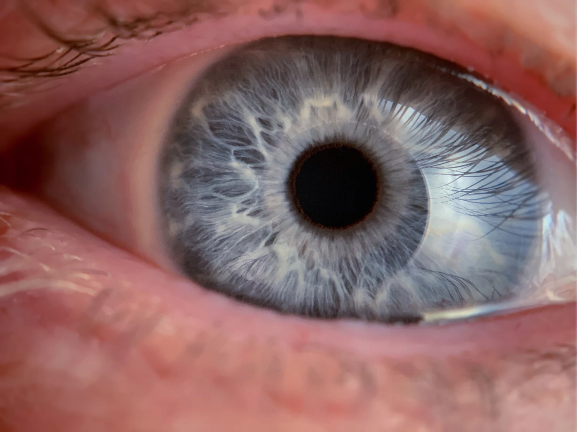 Cornea Transplant in Turkey